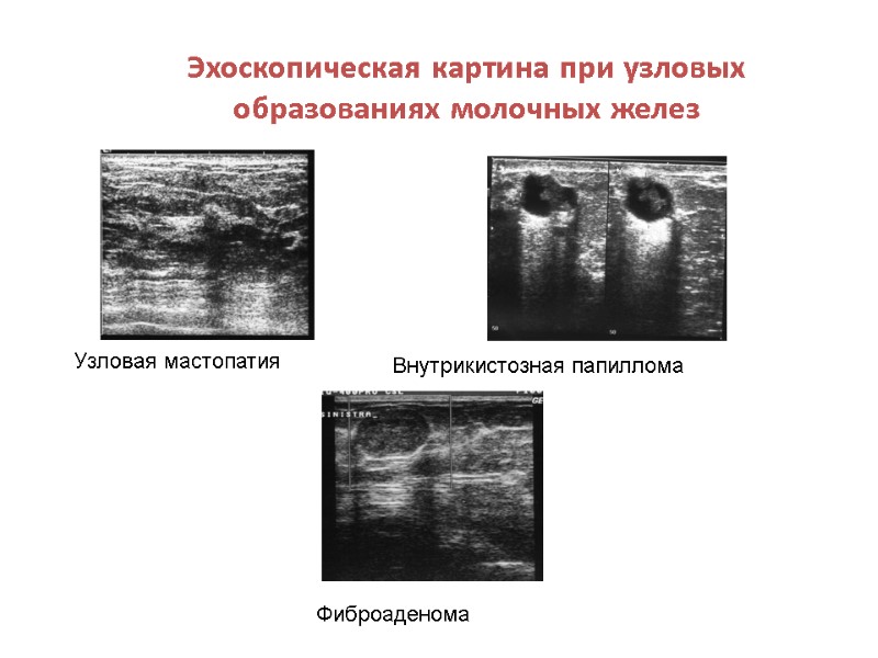 Эхоскопическая картина при узловых образованиях молочных желез Узловая мастопатия Внутрикистозная папиллома Фиброаденома